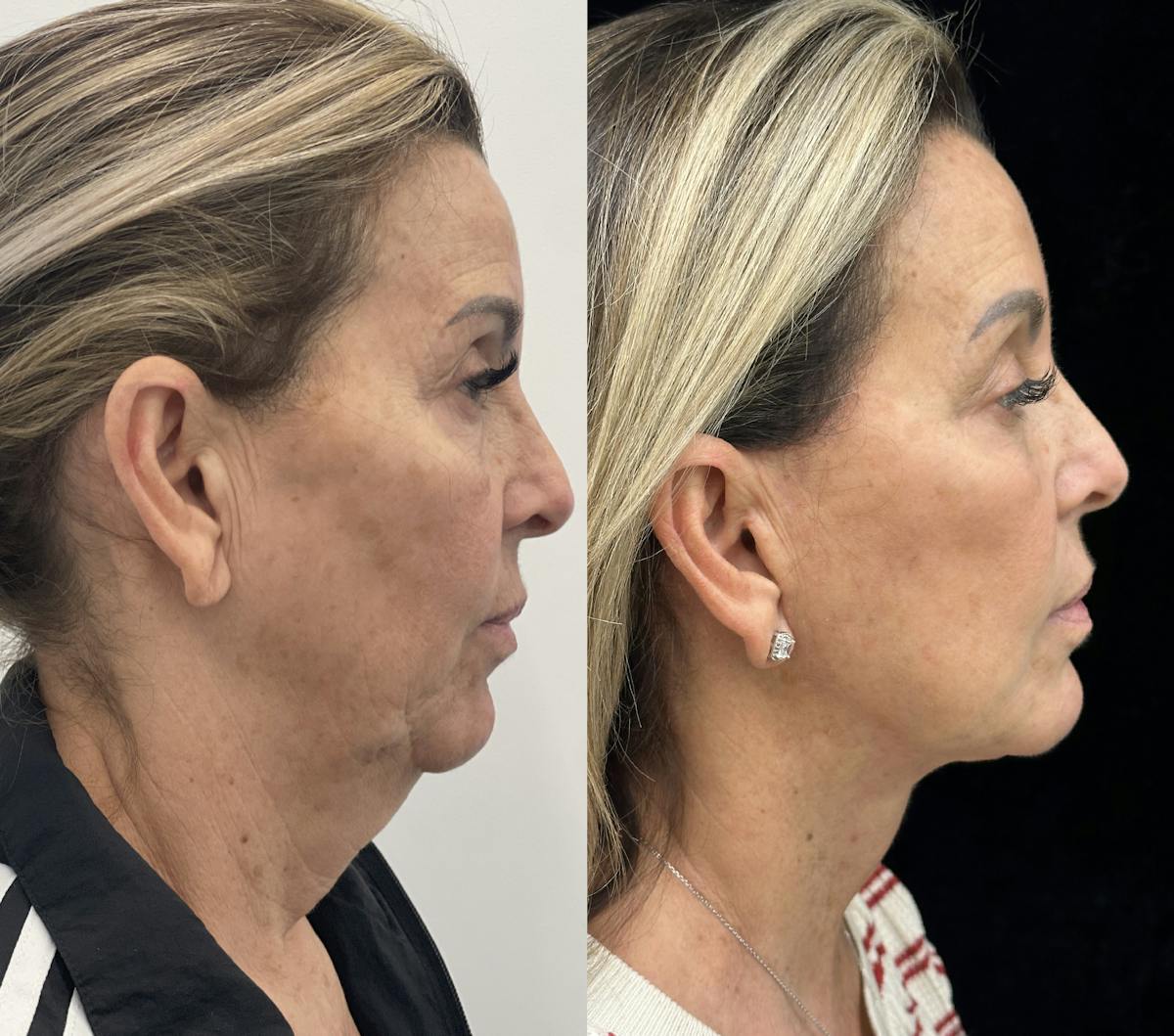 Deep Plane Facelift Before & After Gallery - Patient 141590 - Image 2