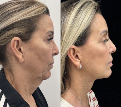 Deep Plane Facelift Before & After Gallery - Patient 141590 - Image 2
