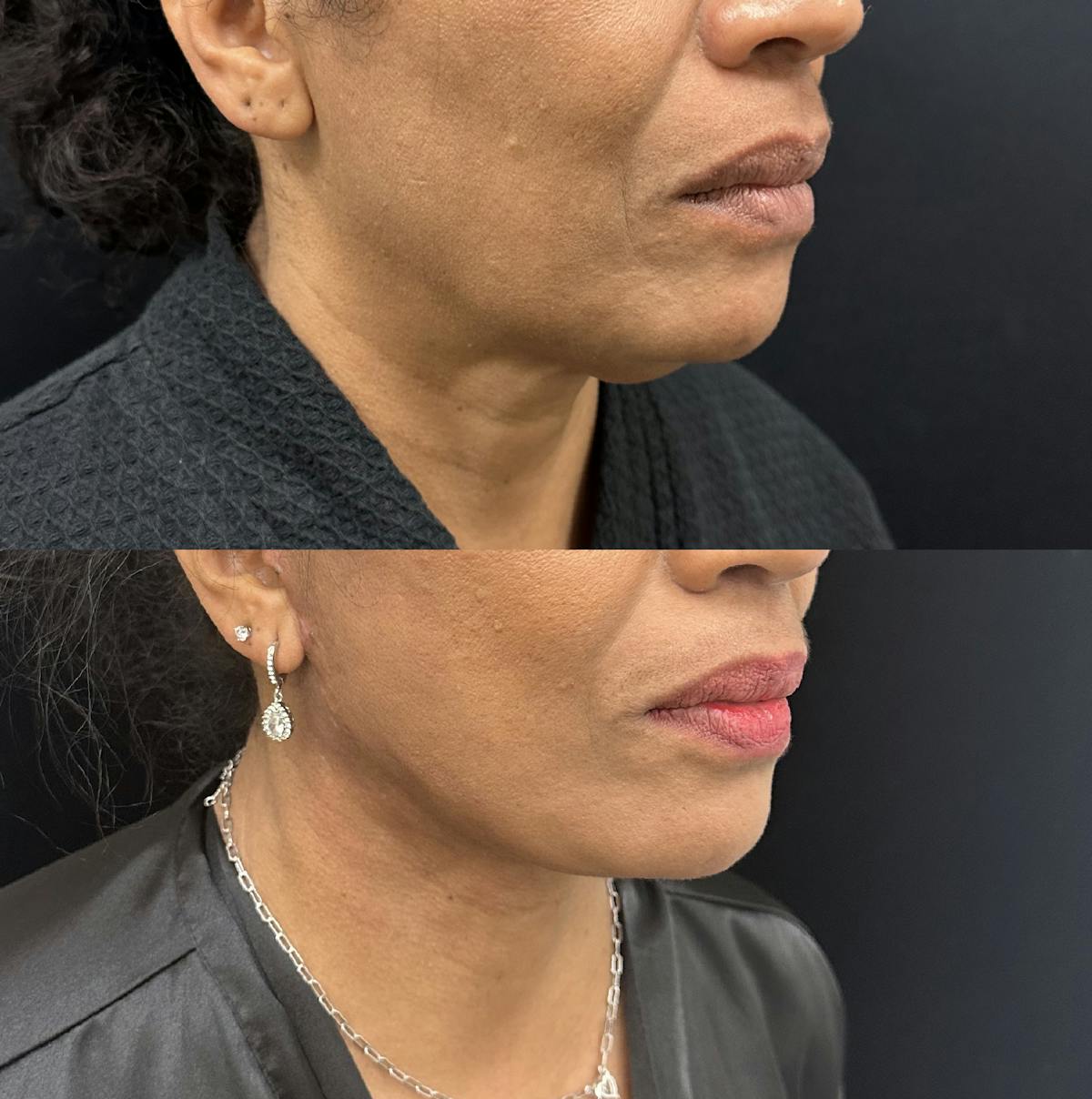 Deep Plane Facelift Before & After Gallery - Patient 364647 - Image 1