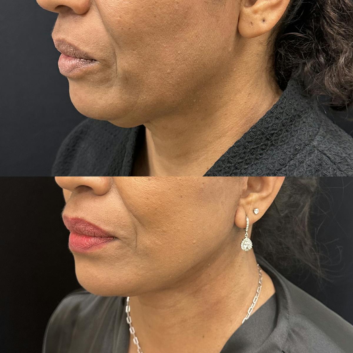 Deep Plane Facelift Before & After Gallery - Patient 364647 - Image 3
