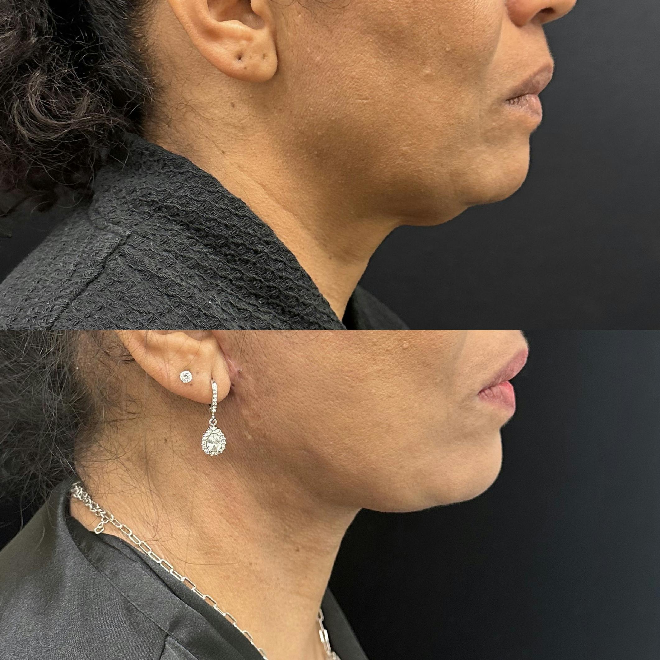 Ethnic Facelift Before & After Gallery - Patient 164785 - Image 2