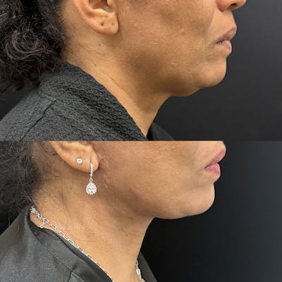 Deep Plane Facelift Before & After Gallery - Patient 364647 - Image 2