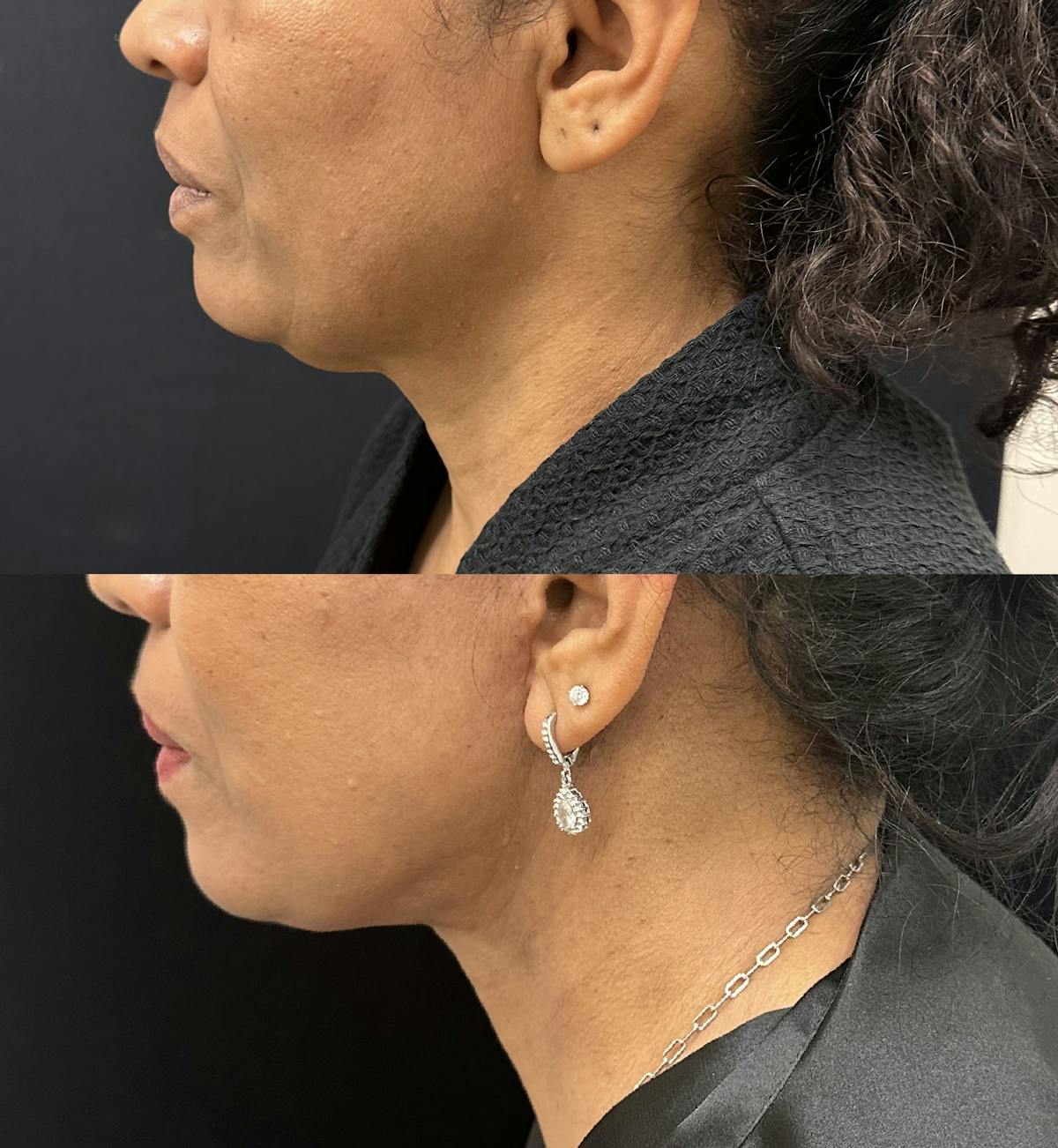 Deep Plane Facelift Before & After Gallery - Patient 364647 - Image 4