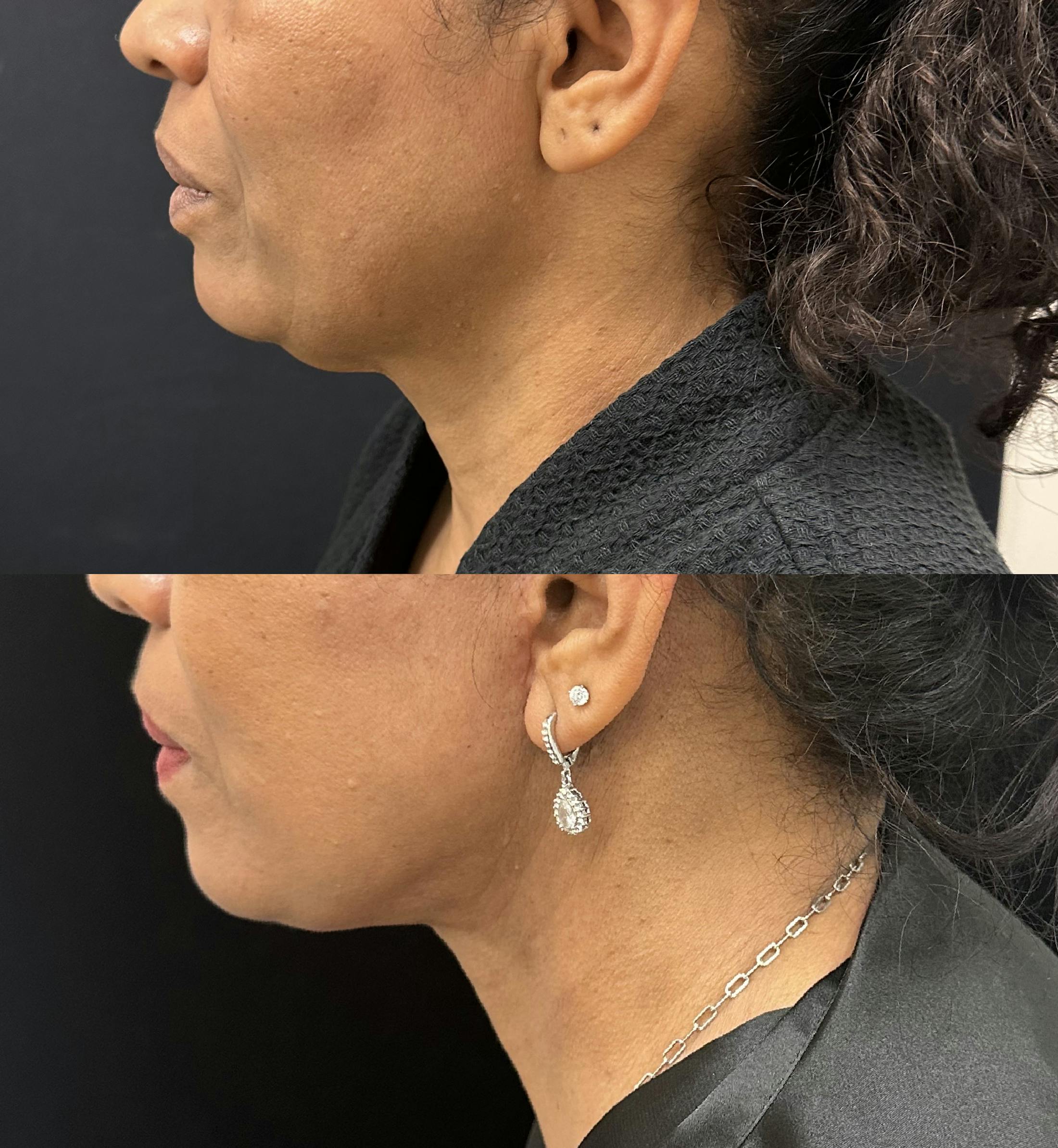 Ethnic Facelift Before & After Gallery - Patient 164785 - Image 4