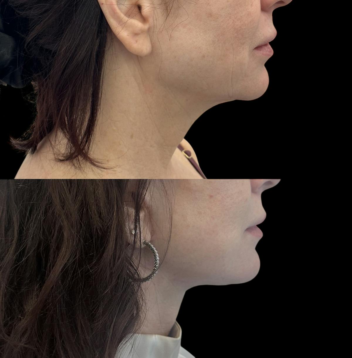Deep Plane Facelift Before & After Gallery - Patient 136654 - Image 1