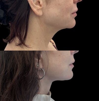 Deep Plane Facelift Before & After Gallery - Patient 136654 - Image 1