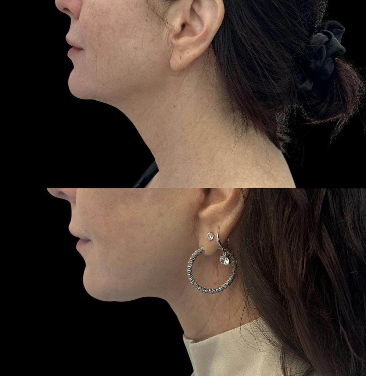 Deep Plane Facelift Before & After Gallery - Patient 136654 - Image 2