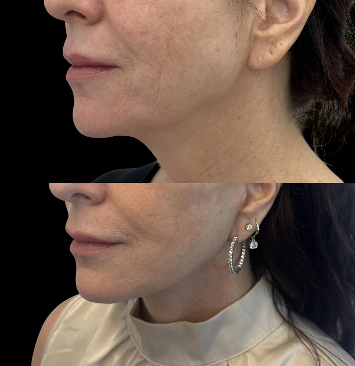Deep Plane Facelift Before & After Gallery - Patient 136654 - Image 3