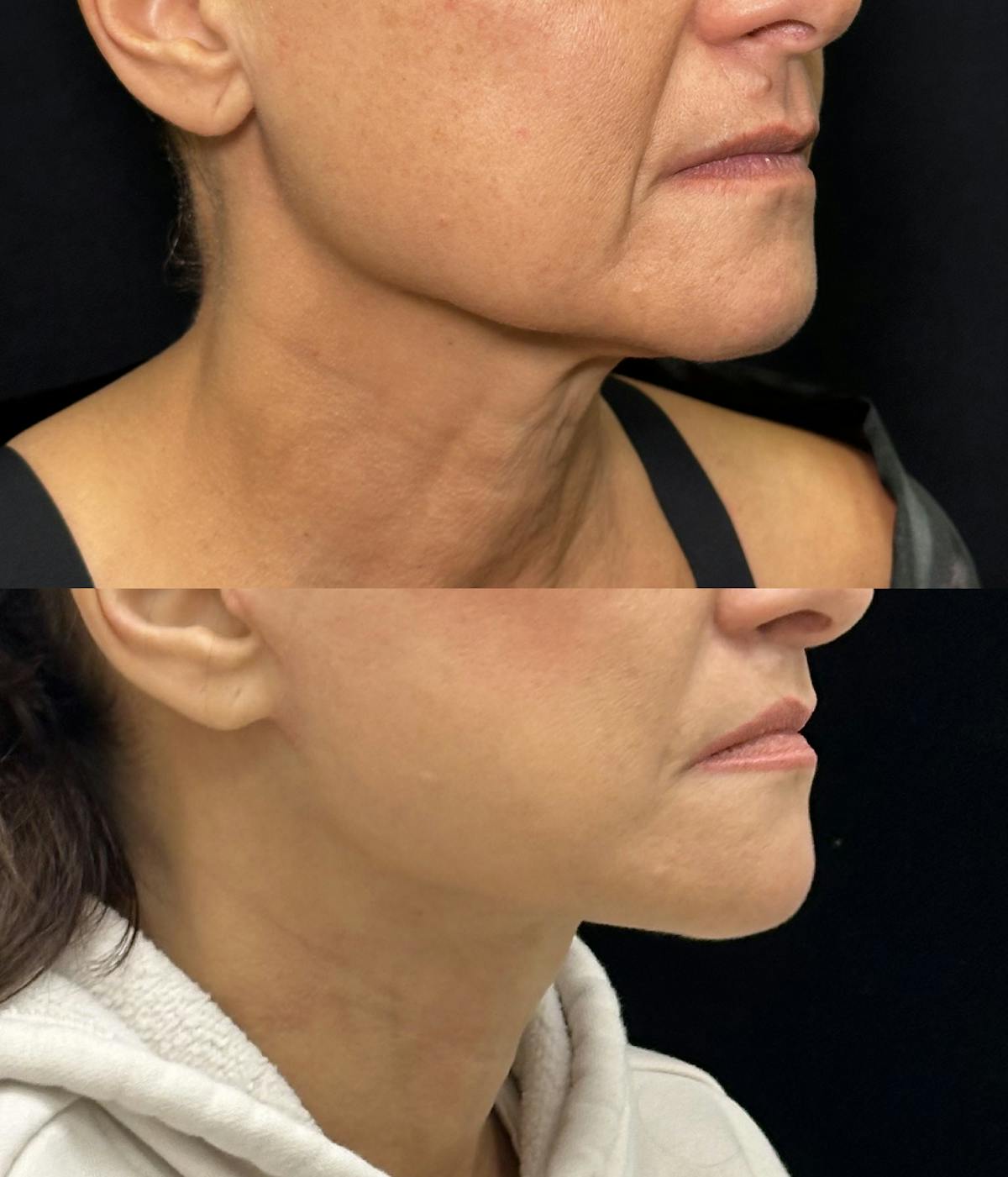 Deep Plane Facelift Before & After Gallery - Patient 222667 - Image 2