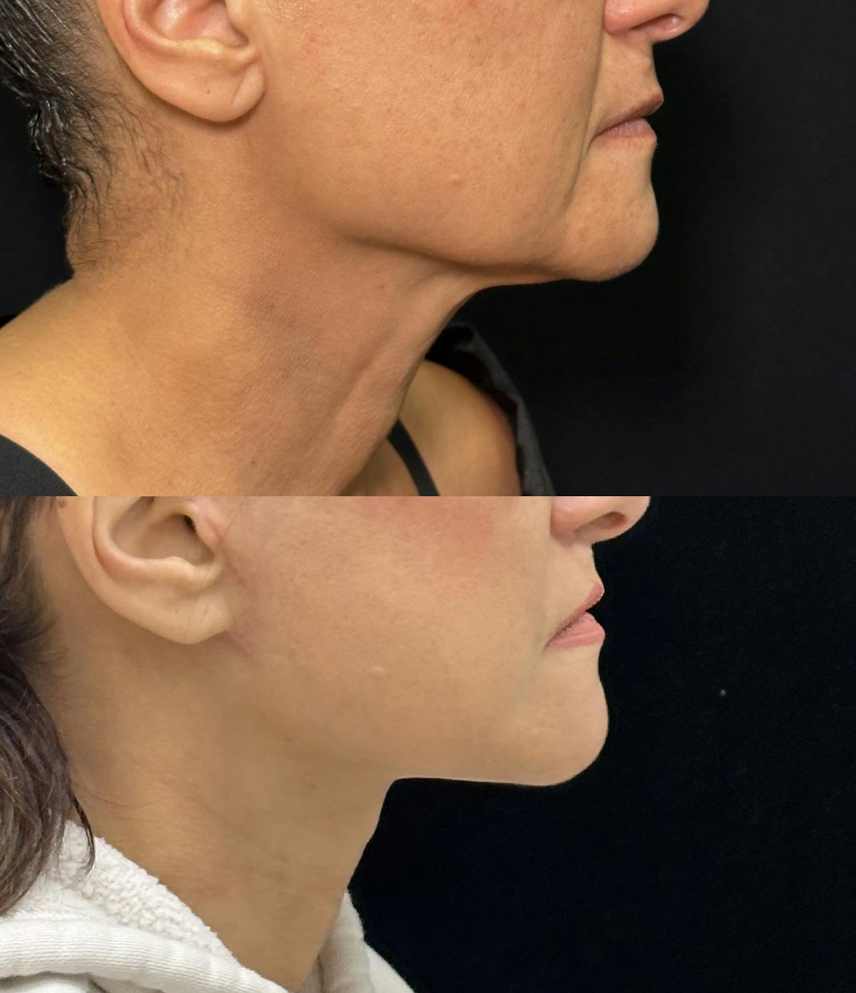 Deep Plane Facelift Before & After Gallery - Patient 222667 - Image 1