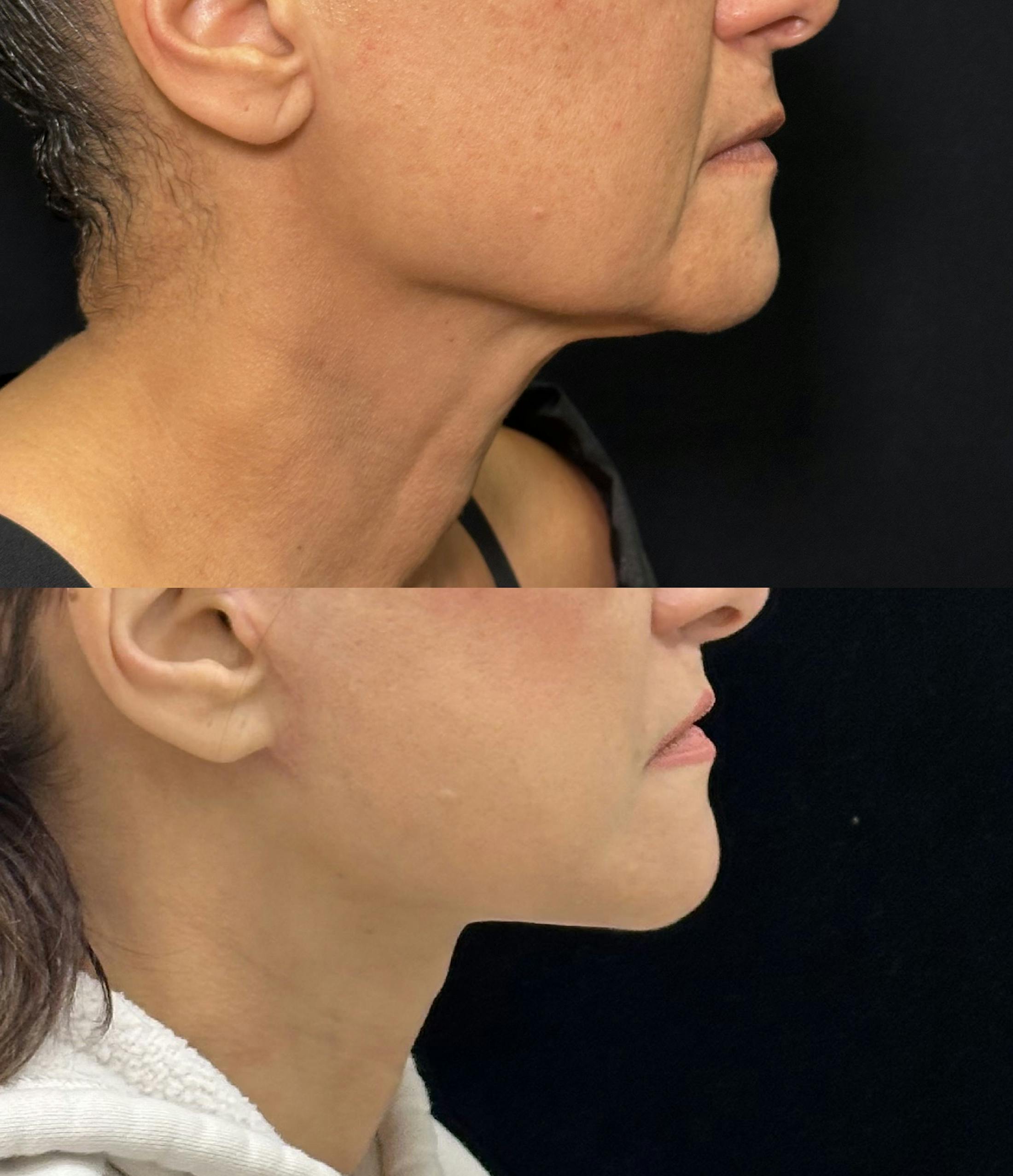 Deep Plane Facelift Before & After Gallery - Patient 222667 - Image 1