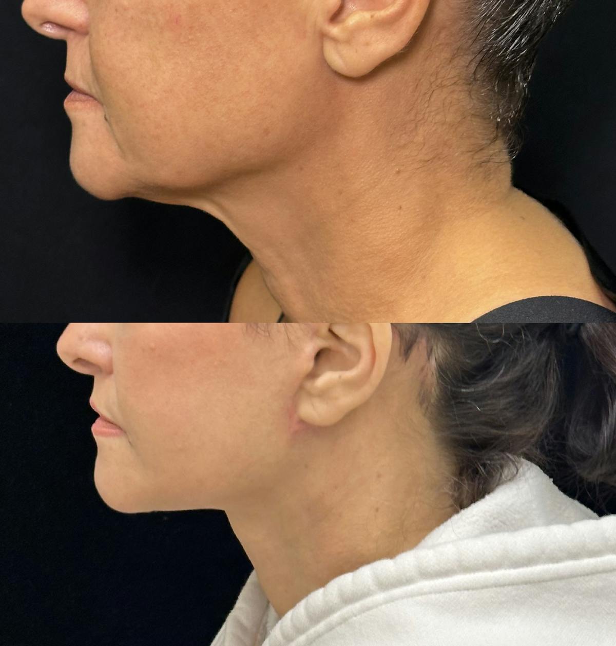 Deep Plane Facelift Before & After Gallery - Patient 222667 - Image 3