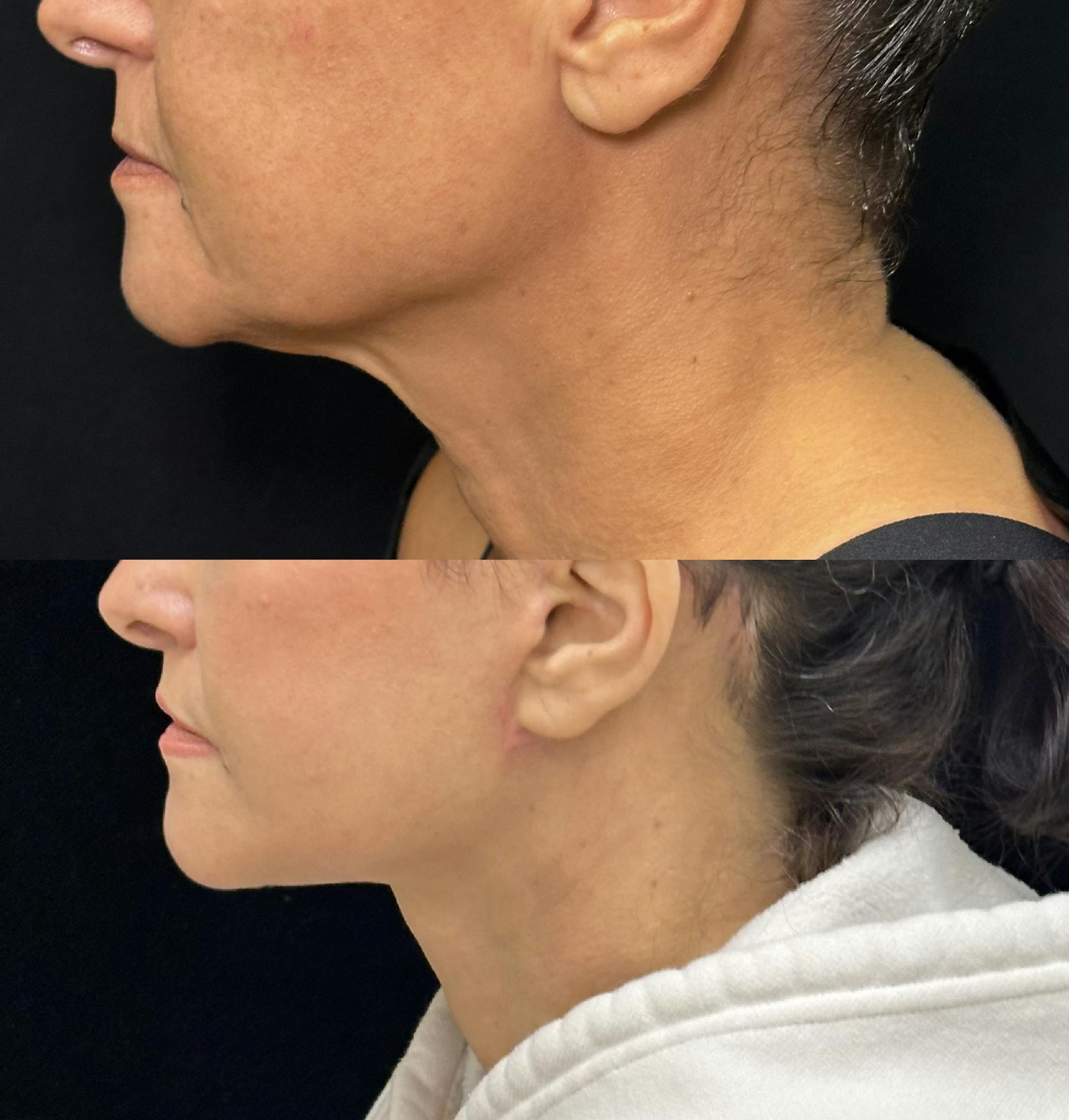 Deep Plane Facelift Before & After Gallery - Patient 222667 - Image 3