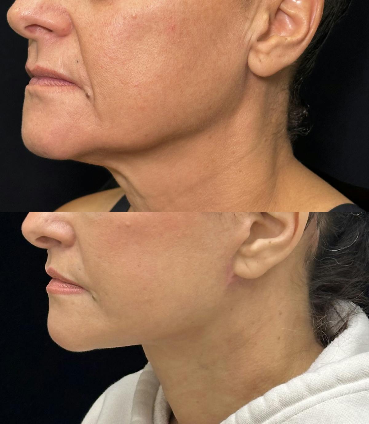 Deep Plane Facelift Before & After Gallery - Patient 222667 - Image 4