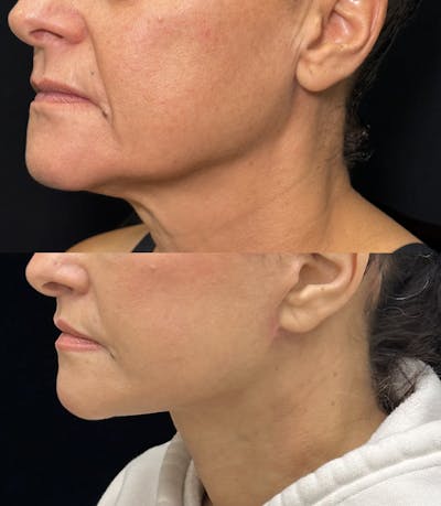 Deep Plane Facelift Before & After Gallery - Patient 222667 - Image 4
