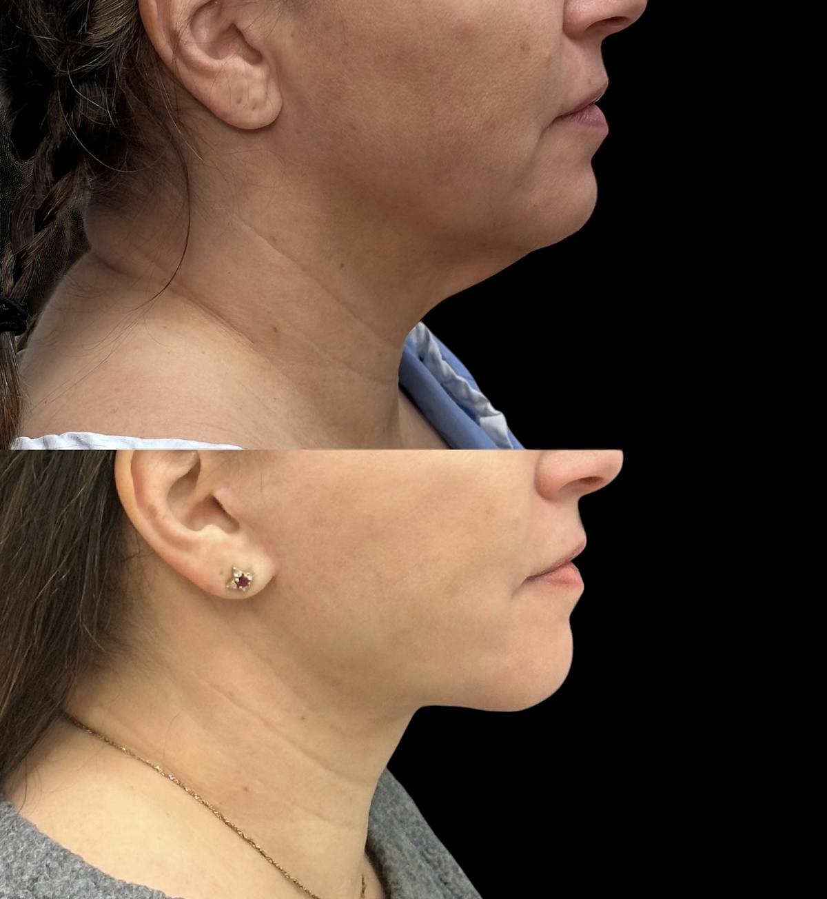 Deep Plane Facelift Before & After Gallery - Patient 805386 - Image 3