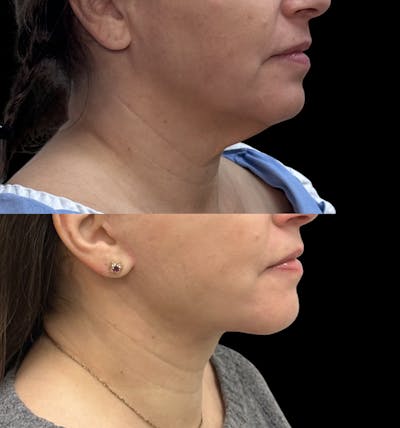Deep Plane Facelift Before & After Gallery - Patient 805386 - Image 2