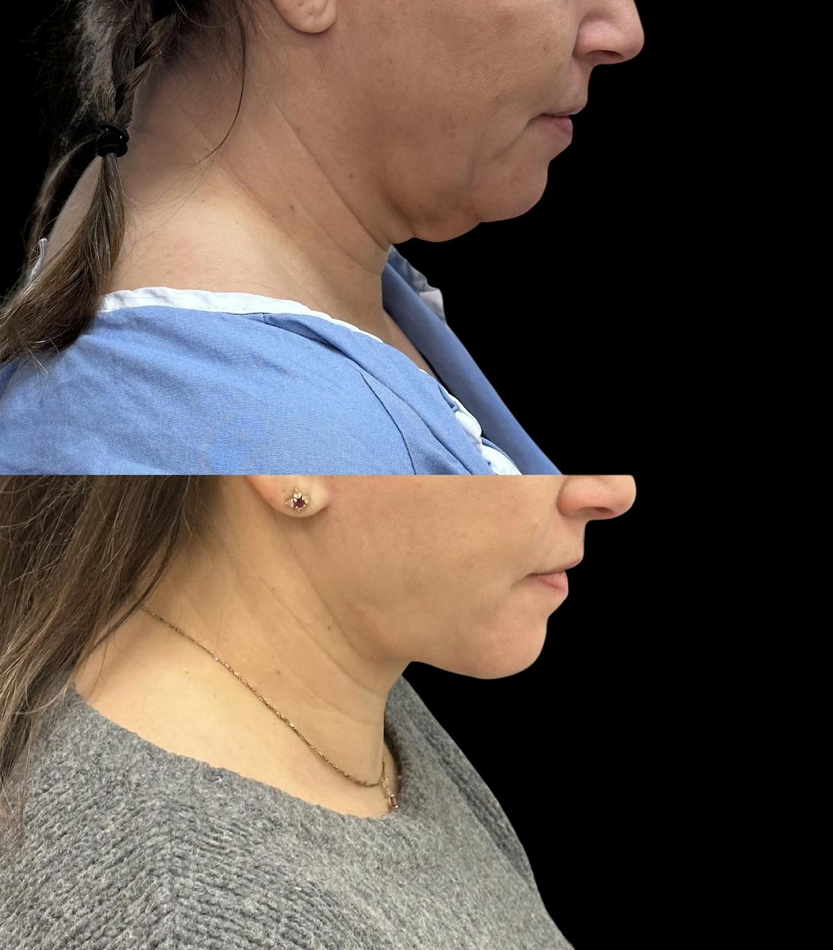 Deep Plane Facelift Before & After Gallery - Patient 805386 - Image 4
