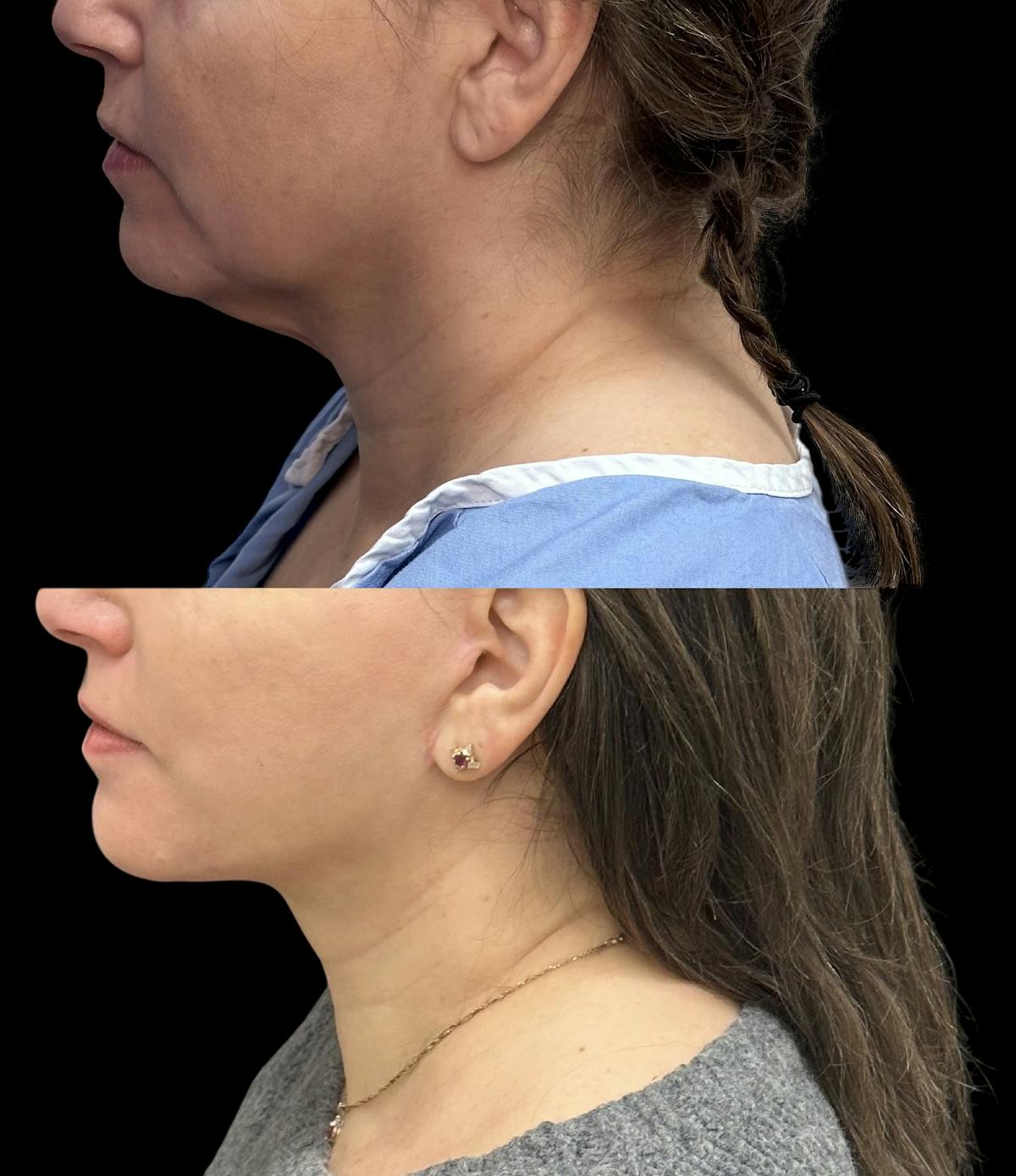 Deep Plane Facelift Before & After Gallery - Patient 805386 - Image 6