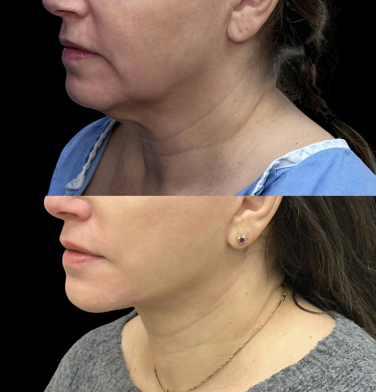 Deep Plane Facelift Before & After Gallery - Patient 805386 - Image 5