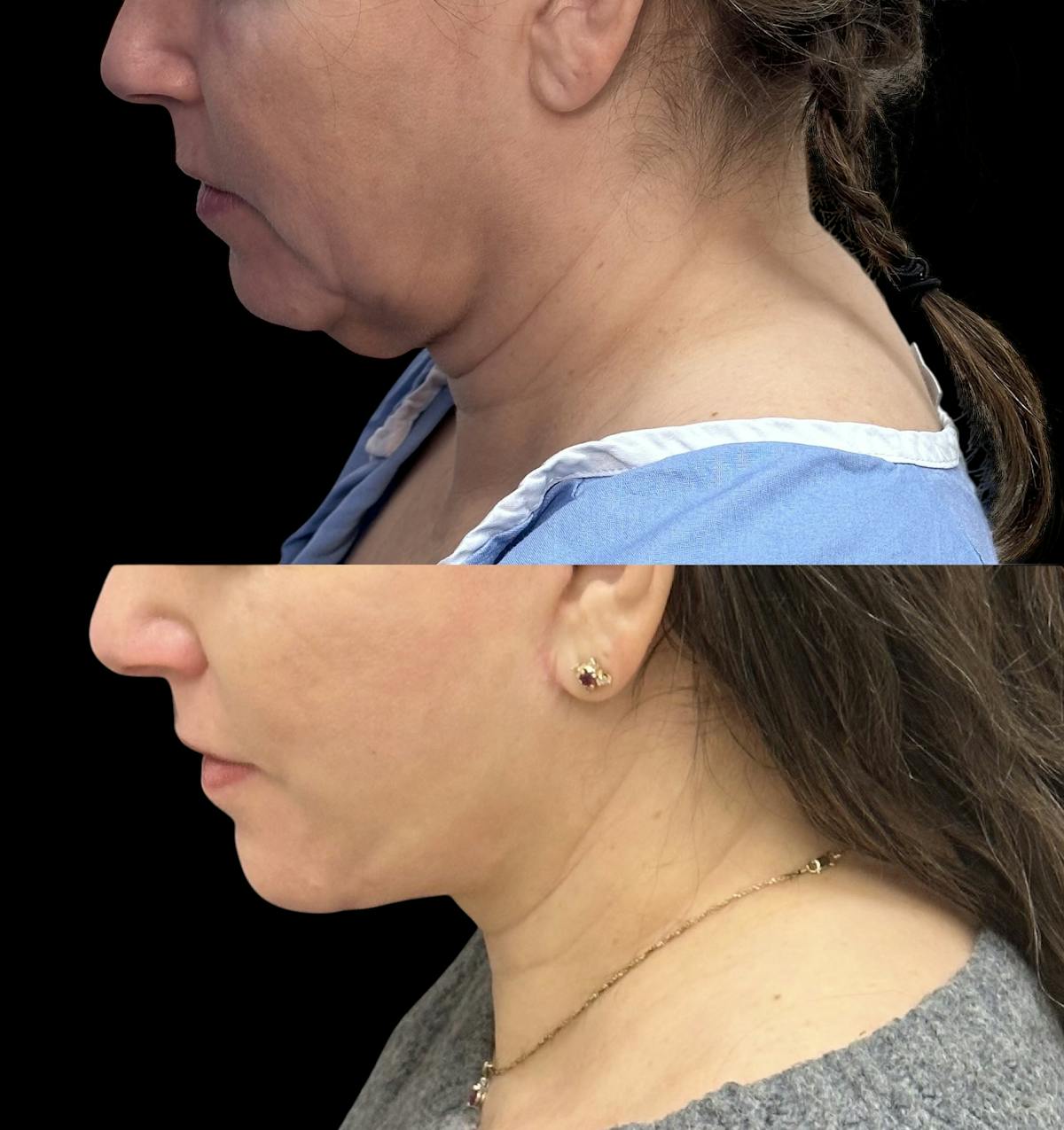 Deep Plane Facelift Before & After Gallery - Patient 805386 - Image 7