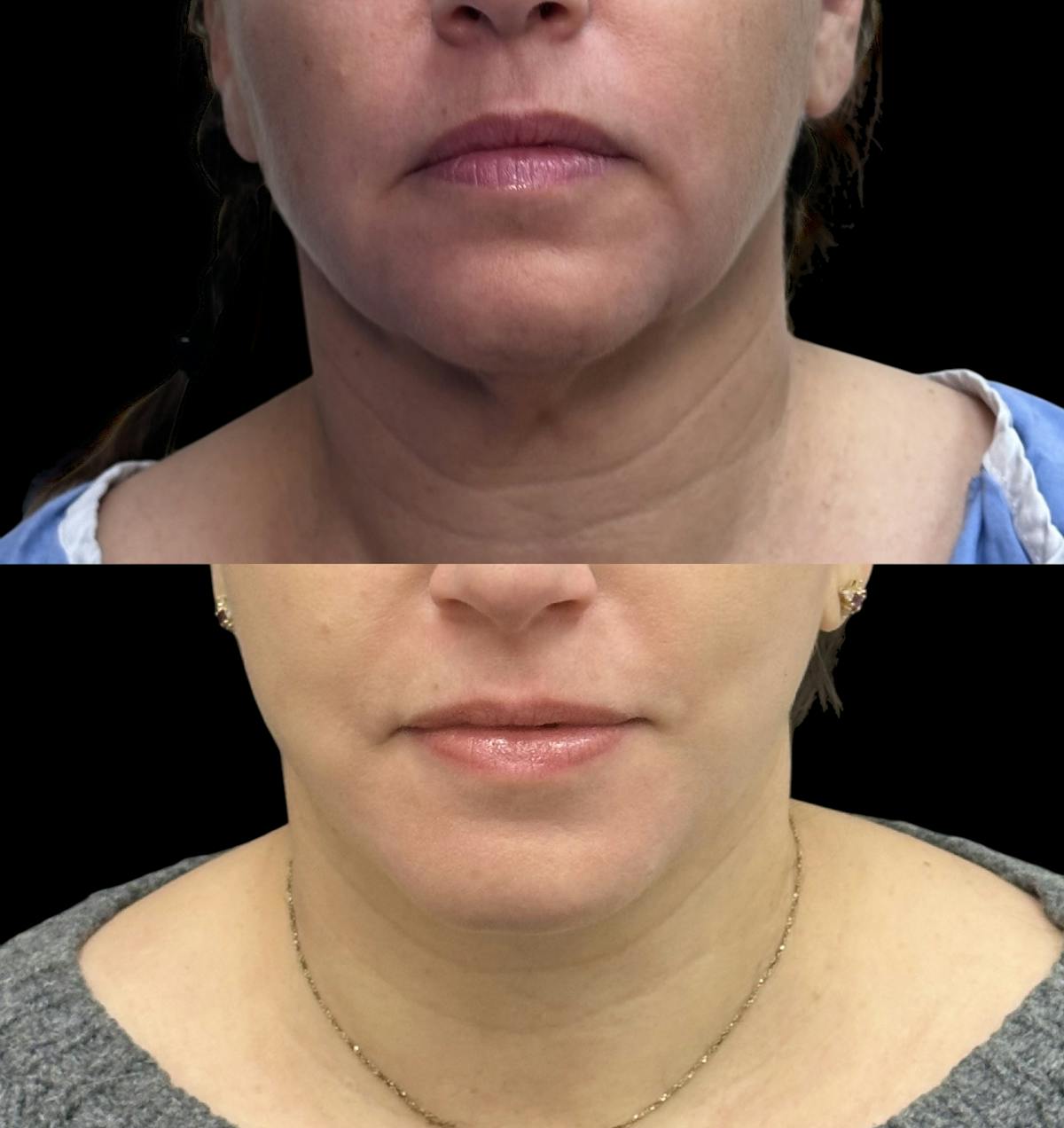 Deep Plane Facelift Before & After Gallery - Patient 805386 - Image 1
