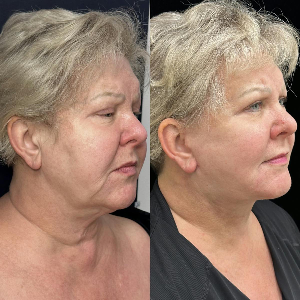 Deep Plane Facelift Before & After Gallery - Patient 369047 - Image 2