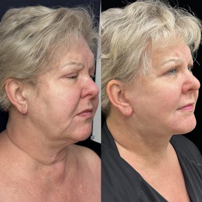 Deep Plane Facelift Before & After Gallery - Patient 369047 - Image 2