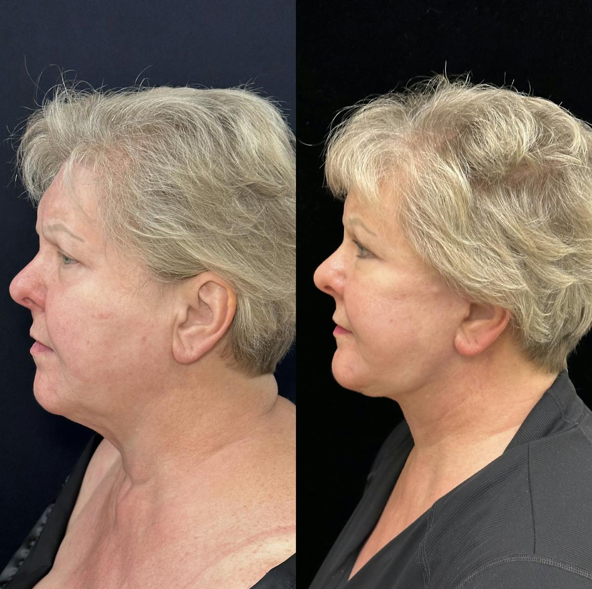 Deep Plane Facelift Before & After Gallery - Patient 369047 - Image 4