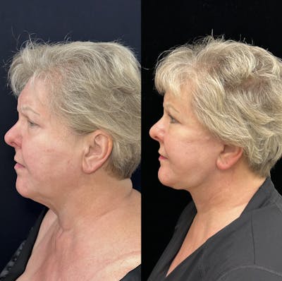 Deep Plane Facelift Before & After Gallery - Patient 369047 - Image 4
