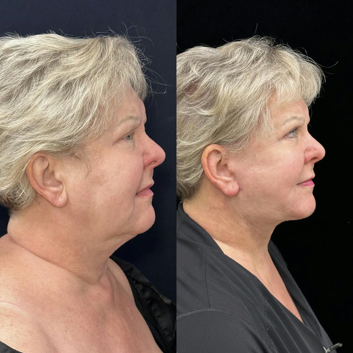 Deep Plane Facelift Before & After Gallery - Patient 369047 - Image 1