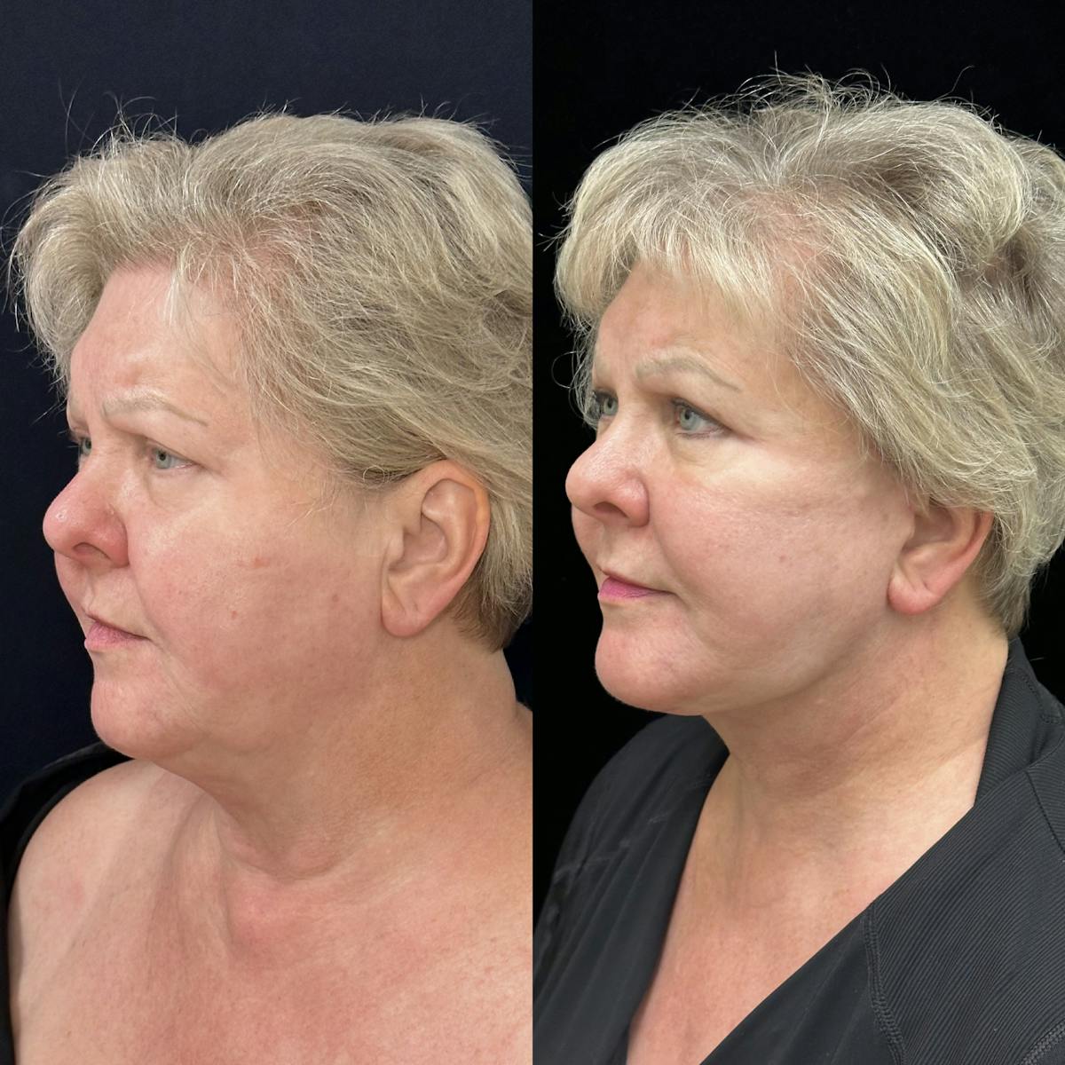 Deep Plane Facelift Before & After Gallery - Patient 369047 - Image 3