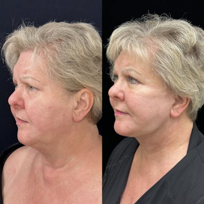 Deep Plane Facelift Before & After Gallery - Patient 369047 - Image 3