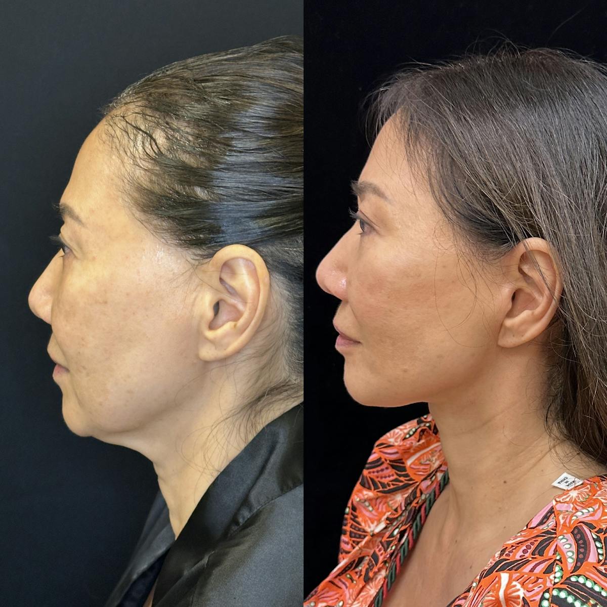 Deep Plane Facelift Before & After Gallery - Patient 378362 - Image 5