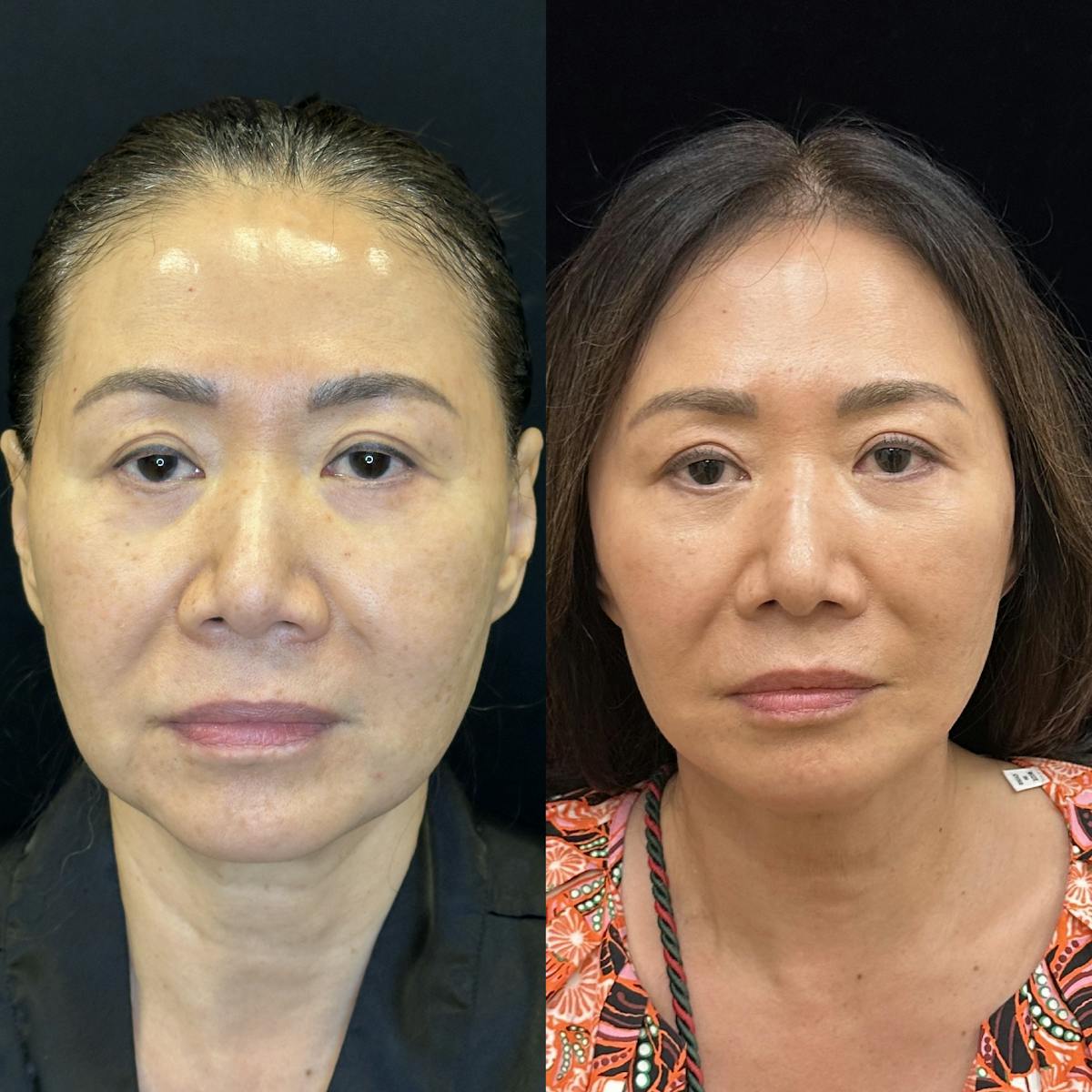 Deep Plane Facelift Before & After Gallery - Patient 378362 - Image 1