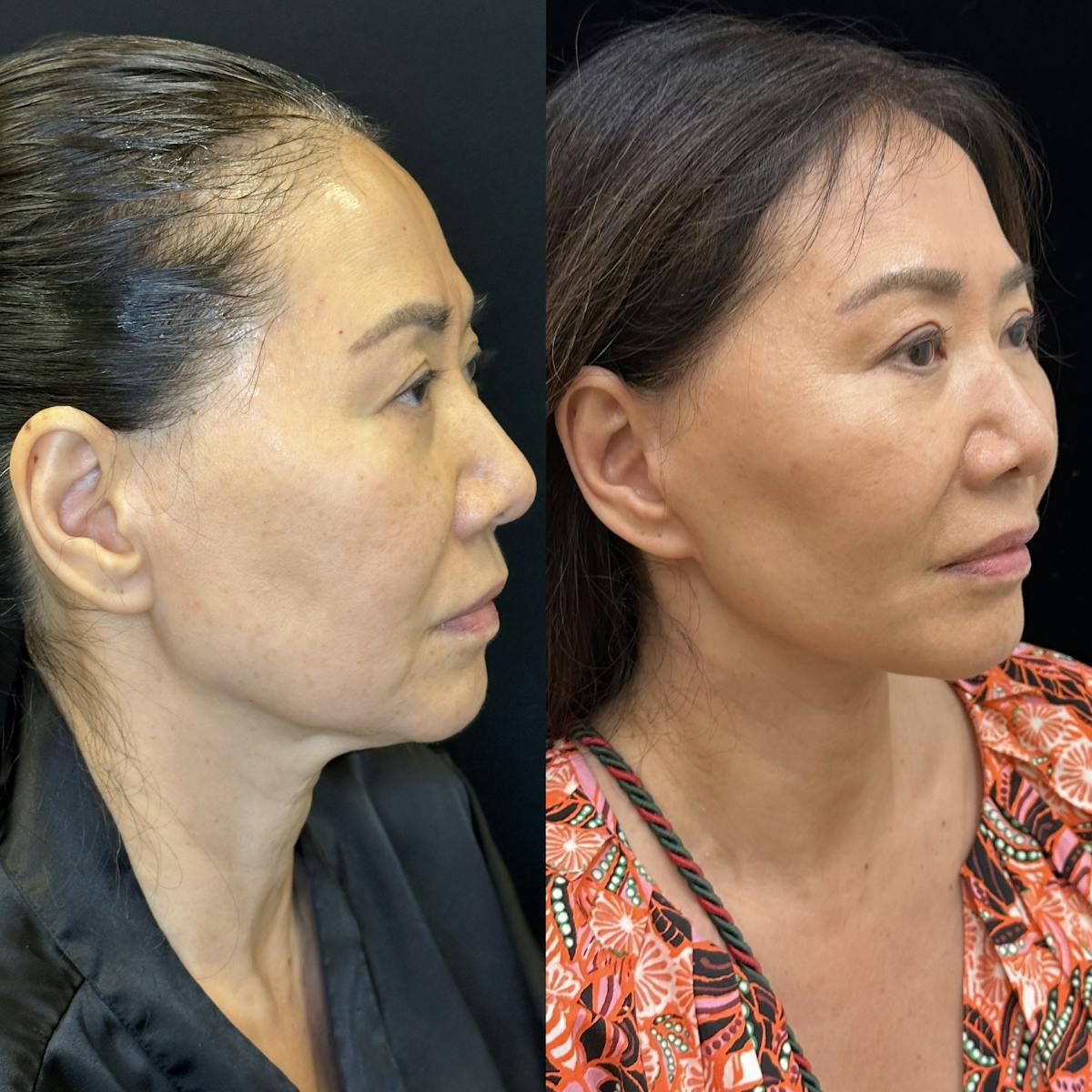 Deep Plane Facelift Before & After Gallery - Patient 378362 - Image 2