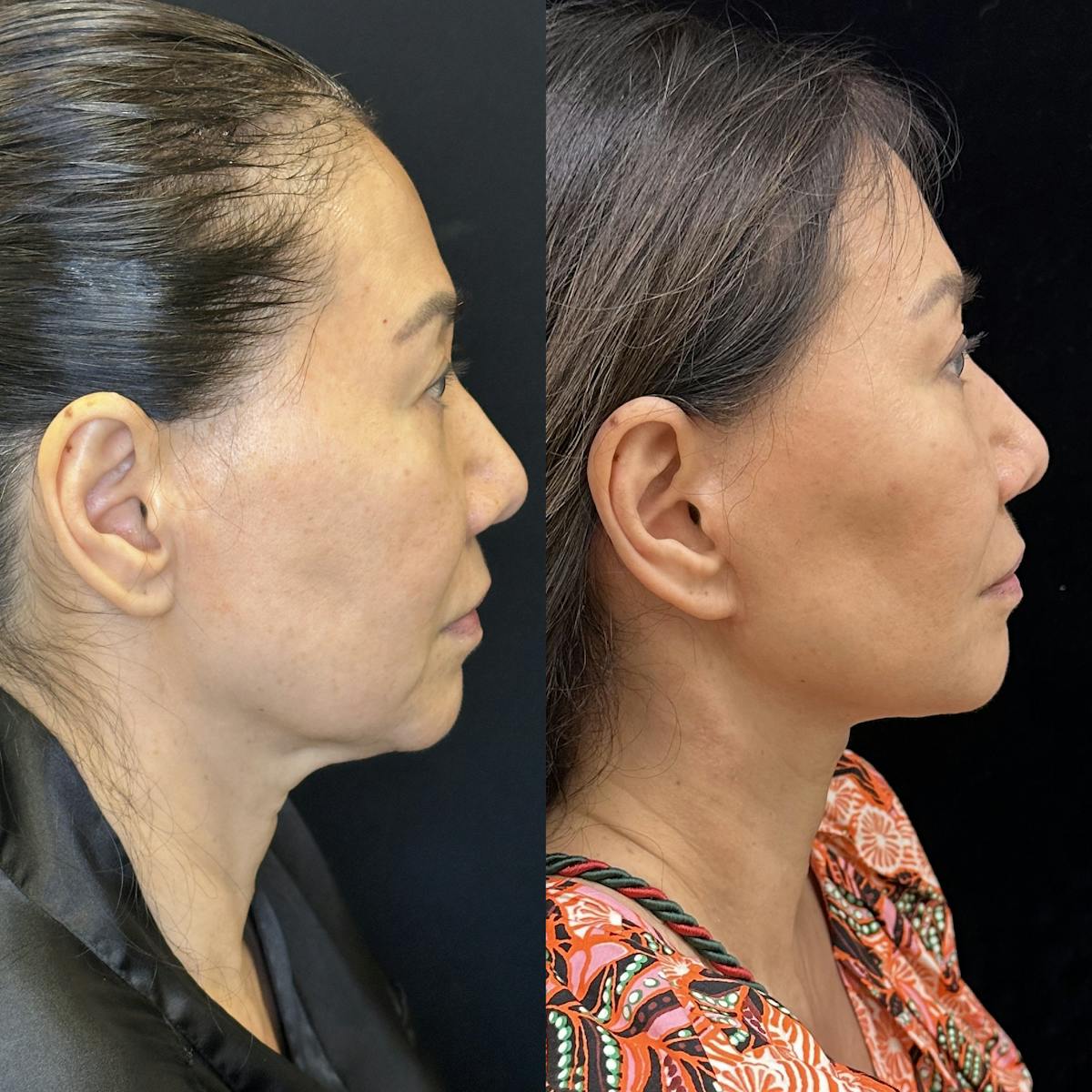 Deep Plane Facelift Before & After Gallery - Patient 378362 - Image 3