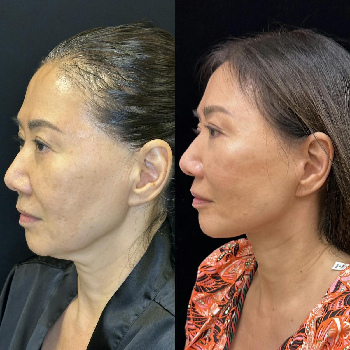Deep Plane Facelift Before & After Gallery - Patient 378362 - Image 4