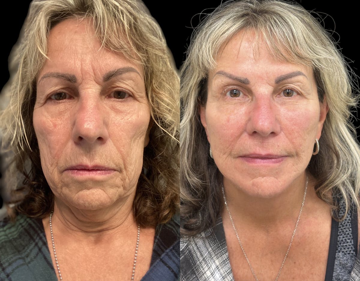 Deep Plane Facelift Before & After Gallery - Patient 294545 - Image 1
