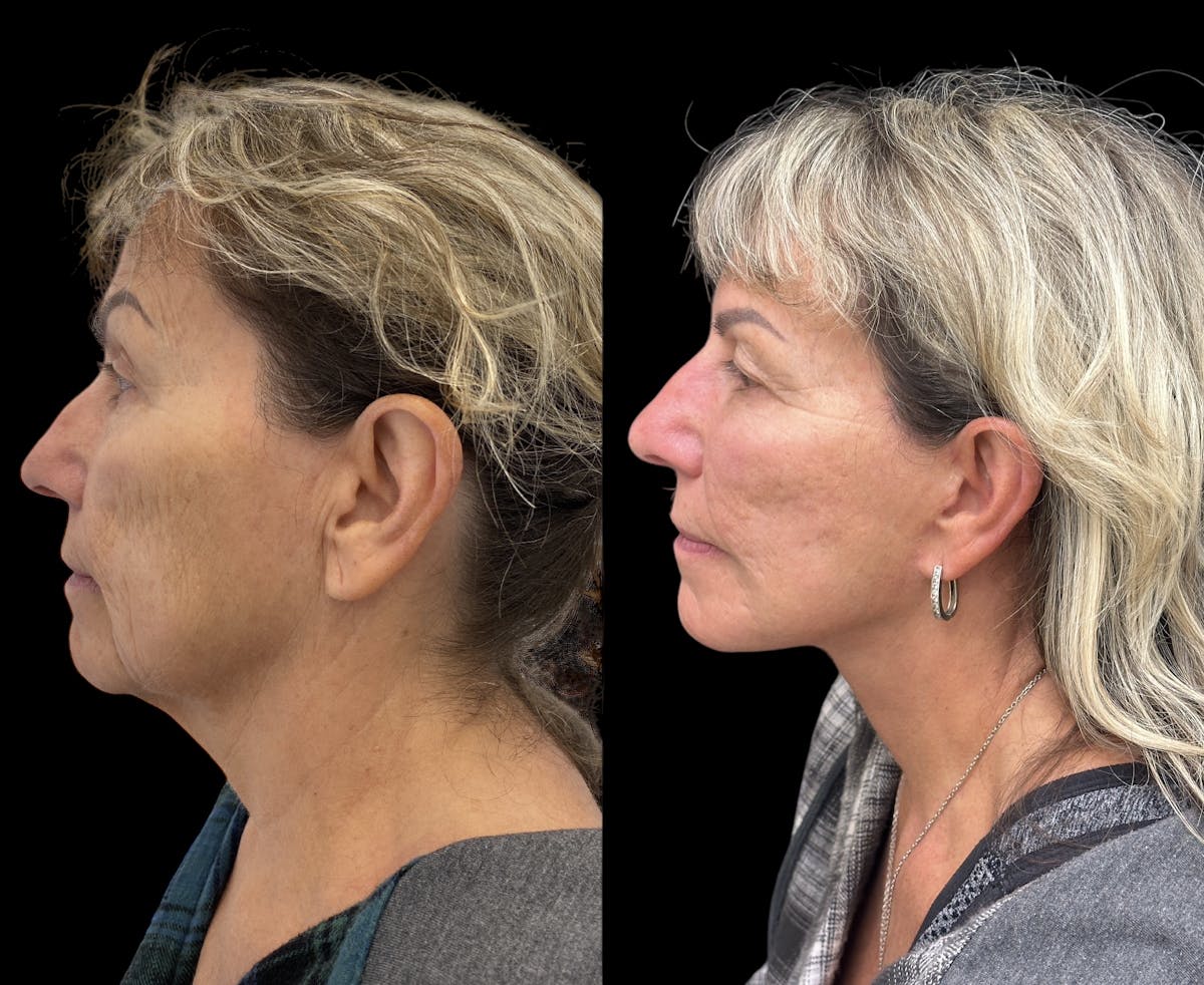 Deep Plane Facelift Before & After Gallery - Patient 294545 - Image 4