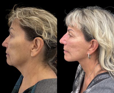 Deep Plane Facelift Before & After Gallery - Patient 294545 - Image 4
