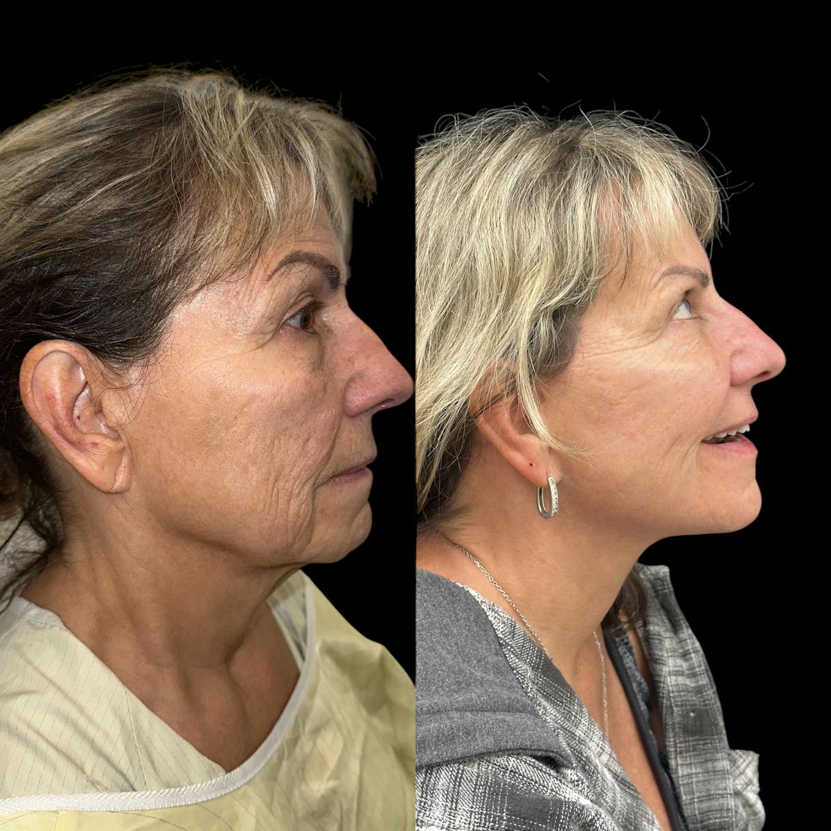 Deep Plane Facelift Before & After Gallery - Patient 294545 - Image 2