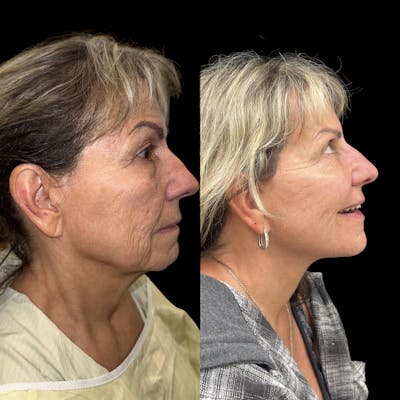 Deep Plane Facelift Before & After Gallery - Patient 294545 - Image 2