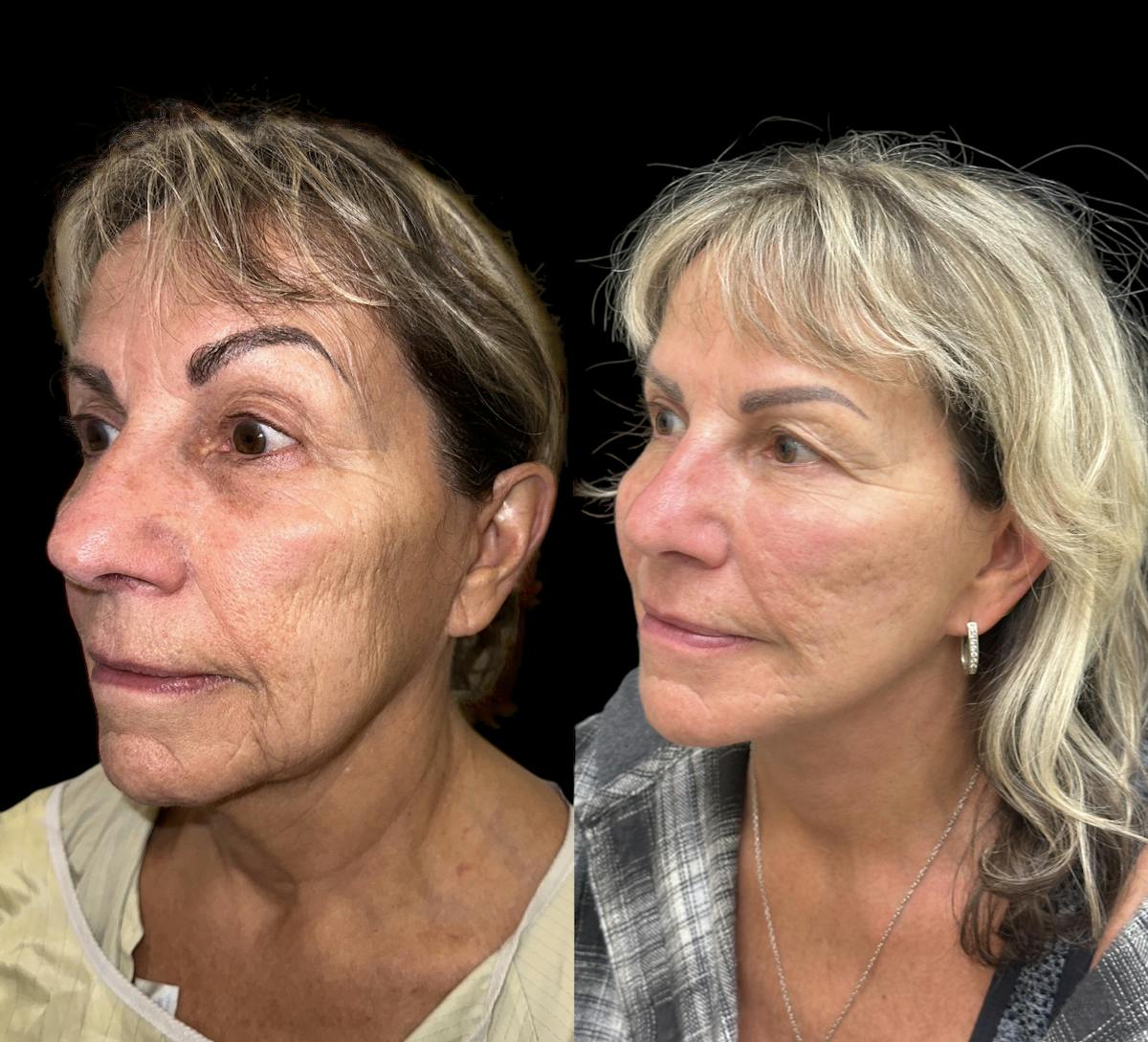 Deep Plane Facelift Before & After Gallery - Patient 294545 - Image 3