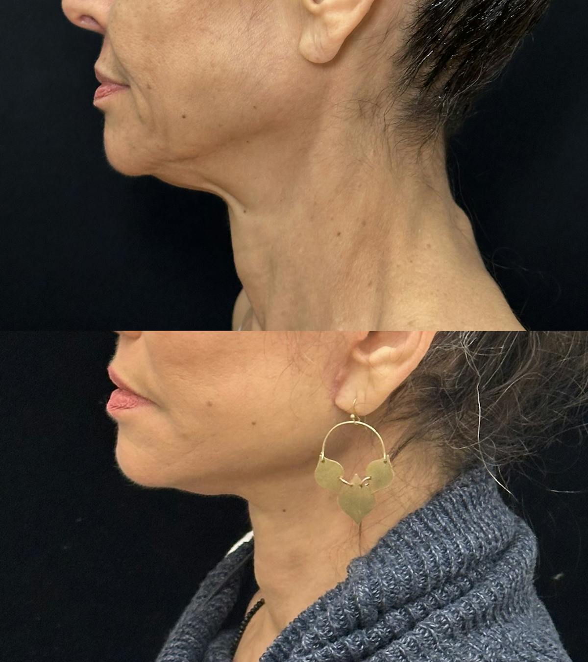 Deep Plane Facelift Before & After Gallery - Patient 195293 - Image 4