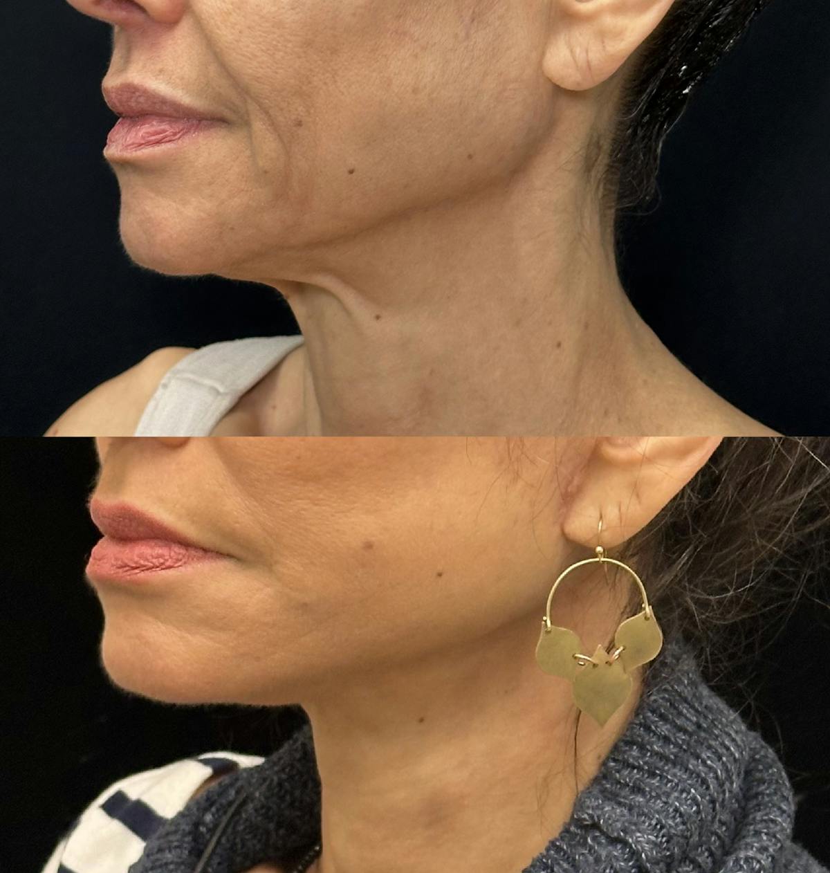 Deep Plane Facelift Before & After Gallery - Patient 195293 - Image 3