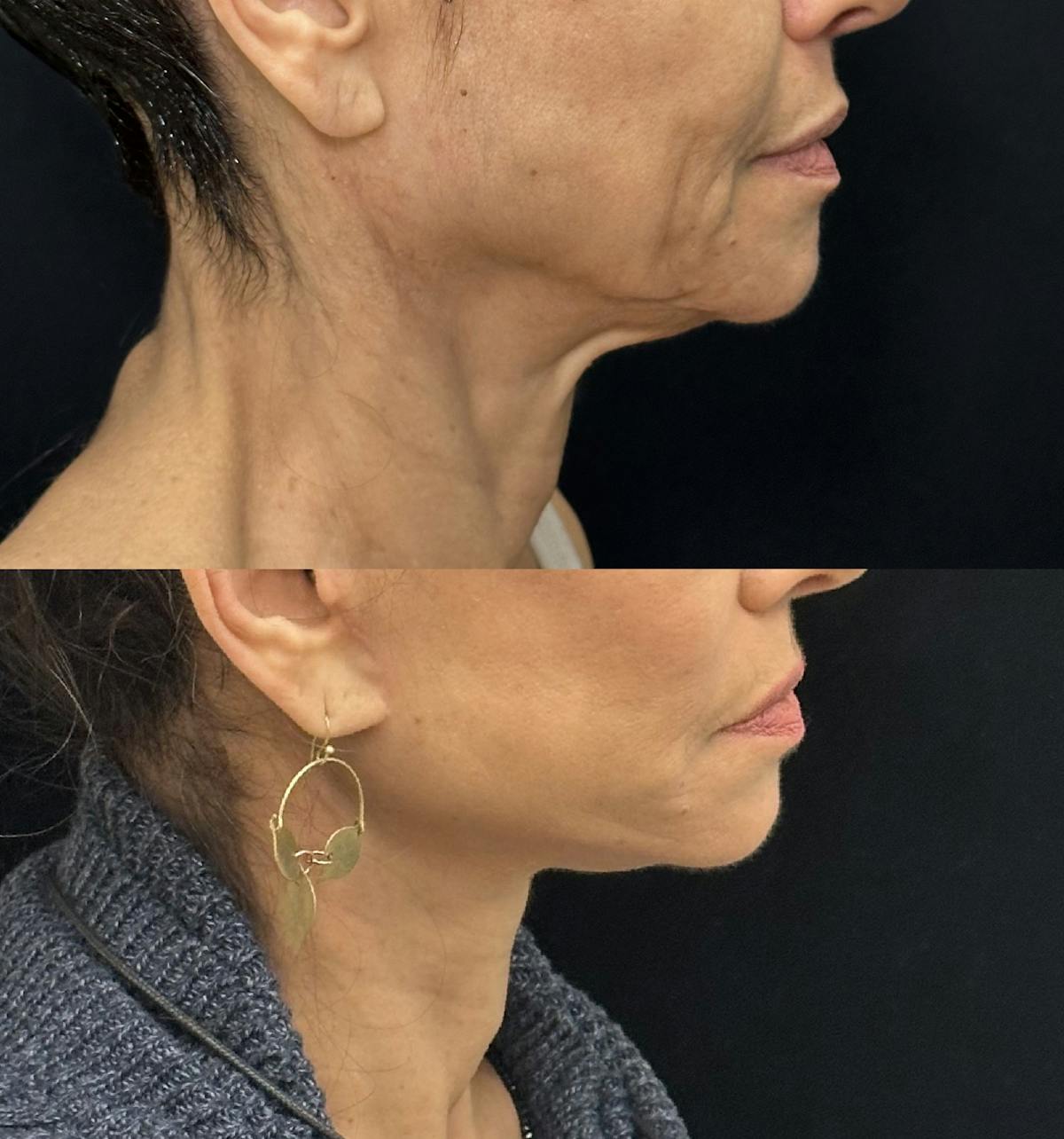 Deep Plane Facelift Before & After Gallery - Patient 195293 - Image 1