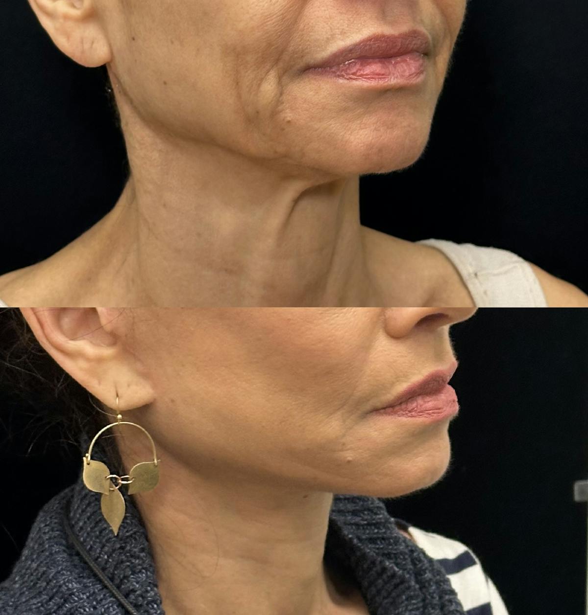 Deep Plane Facelift Before & After Gallery - Patient 195293 - Image 2