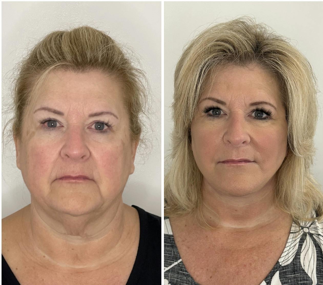 Deep Plane Facelift Before & After Gallery - Patient 138997 - Image 1