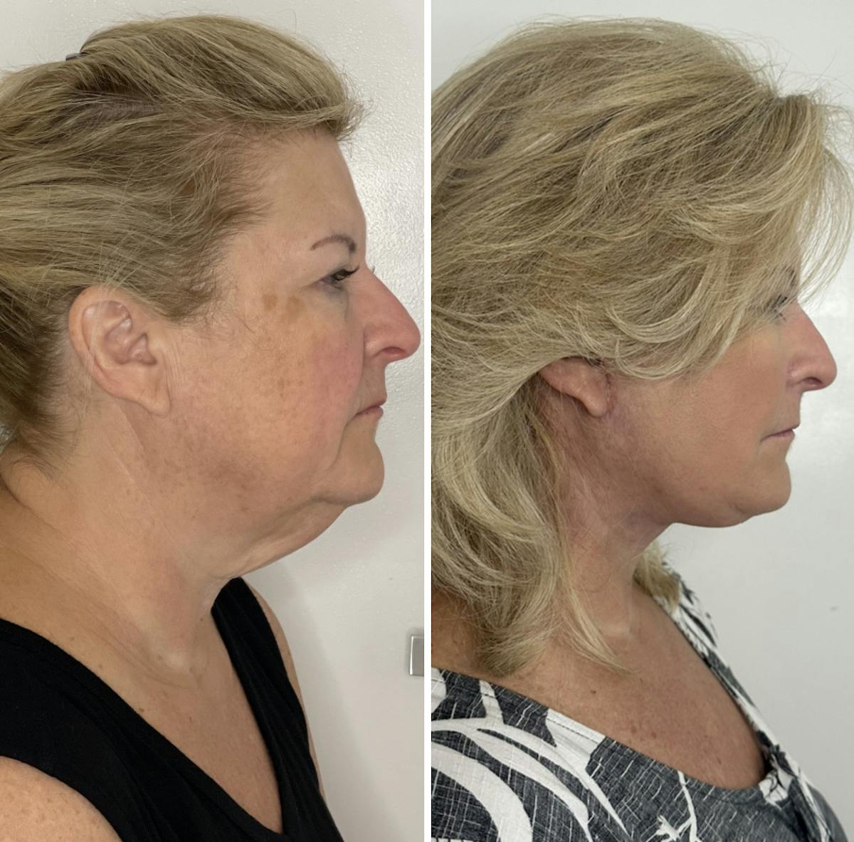Deep Plane Facelift Before & After Gallery - Patient 138997 - Image 3